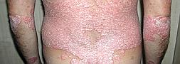 Psoriasis, una patologa ms all de la piel